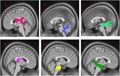 White Matter Tract Alterations in Drug-Naïve Parkinson's Disease Patients With Excessive Daytime Sleepiness